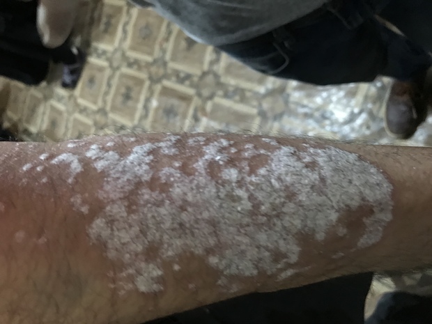 an arm with plaque psoriasis scales