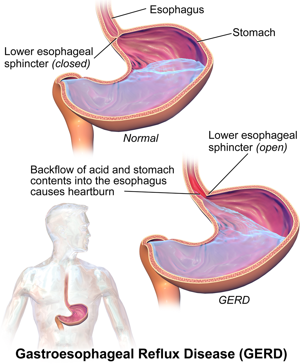 Diagram of how GERD affects the stomach