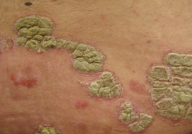 a patch of psoriasis on a person’s body