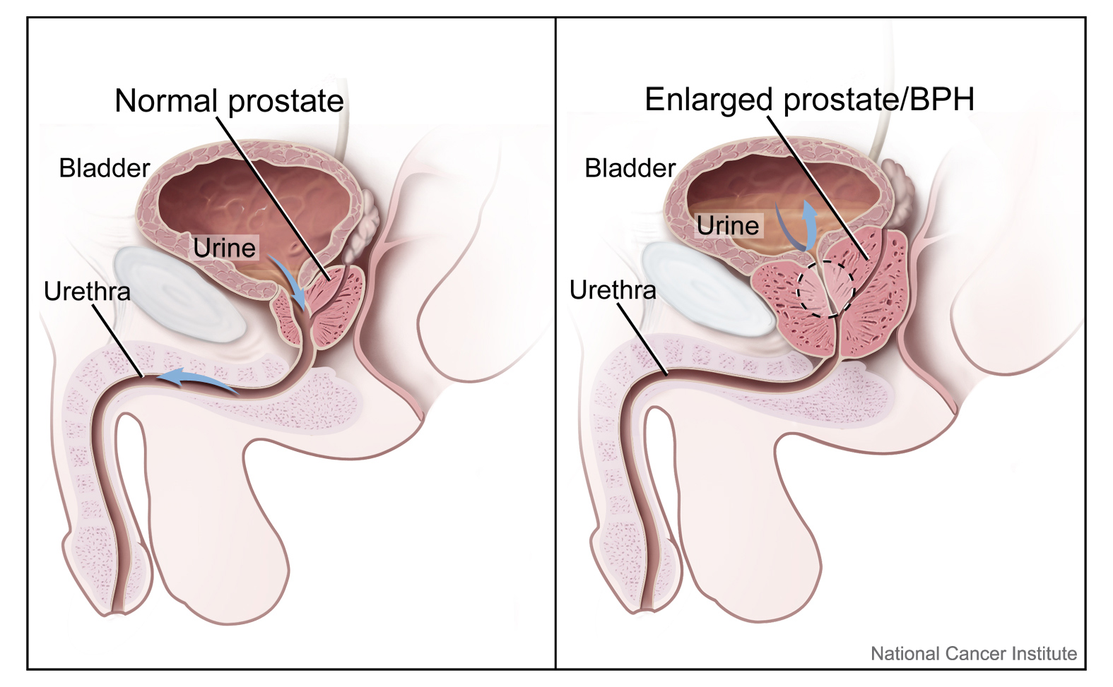 A diagram of a normal prostate vs. an enlarged prostate