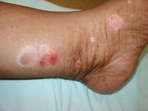 psoriasis on a person’s ankle