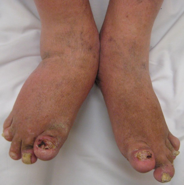 a person’s feet affected by a severe case of psoriatic arthritis