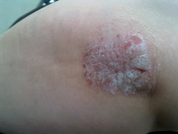 a psoriasis patch on someone’s elbow