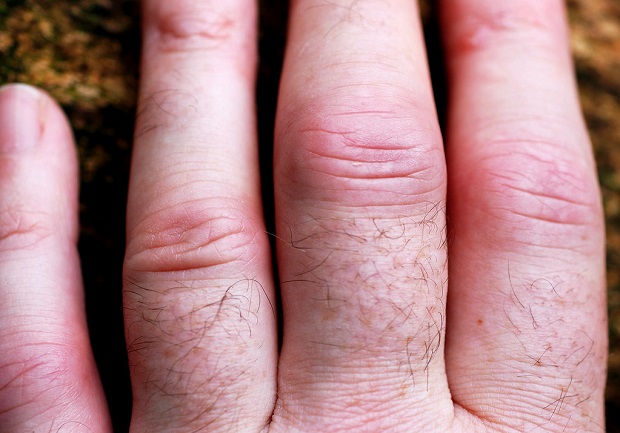 a person’s fingers that are swollen with joint arthritis