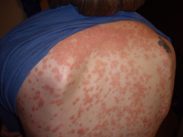 a man’s back with splotchy red patches from Guttate psoriasis
